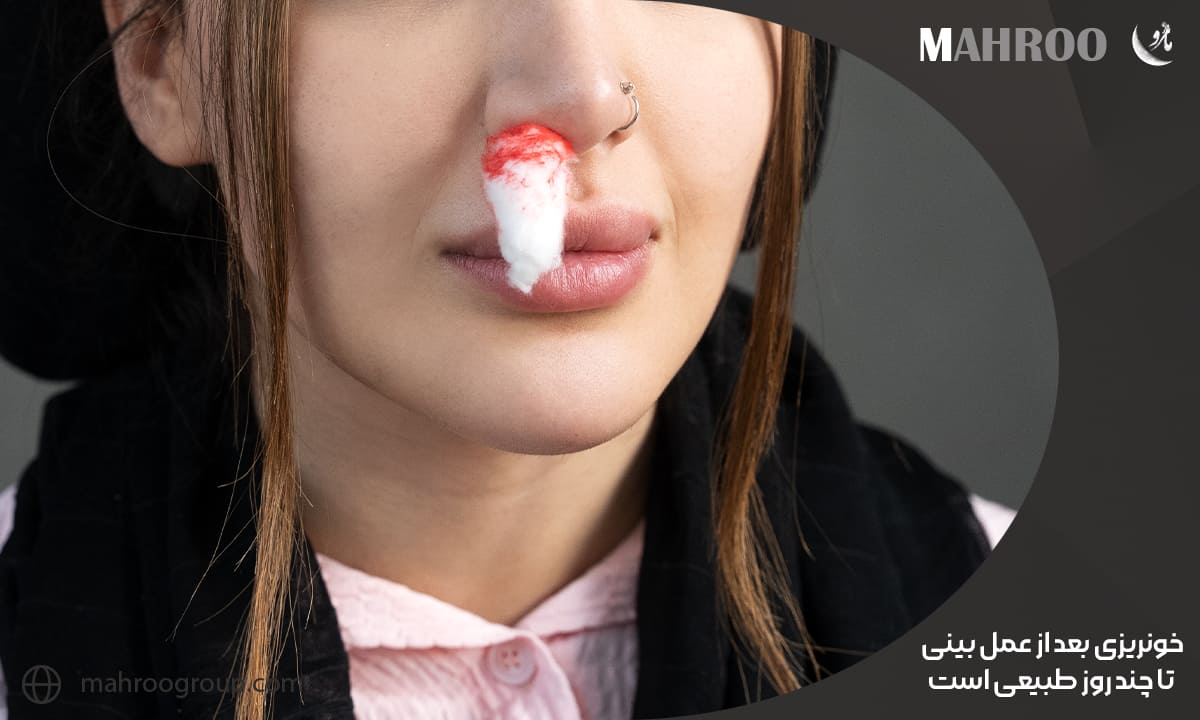 خونریزی بعد از عمل بینی تا چند روز طبیعی است